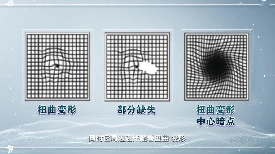 老年性黄斑变性的治疗方法 湿性老年性黄斑变性,可以通过眼内注射