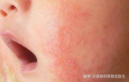 什么是特异性皮炎,特应性皮炎是什么原因造成的,以及日常护理要点.
