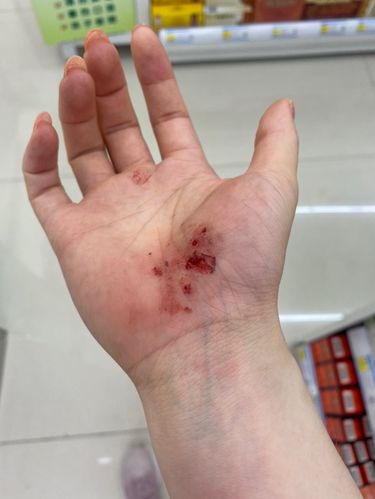 胳膊手又摔伤了[流泪][流泪]还好屁股腿肉多[笑哭],了