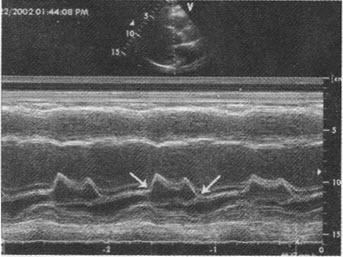 m型超声心动图显示二尖瓣活动曲线,图中箭头所示两点称为()