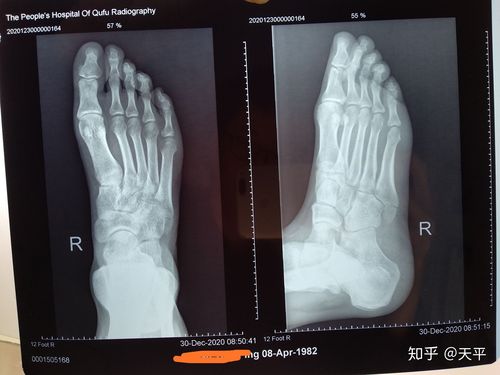 第五跖骨基底部骨折快一月了仍旧不好一月半就愈合了一点听医生说这个