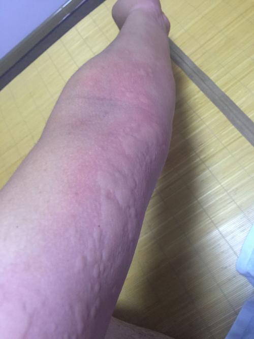 或者是喝酒后身上就会出扁疙瘩,一片一片的,过敏症状,喝酒会有,不喝酒