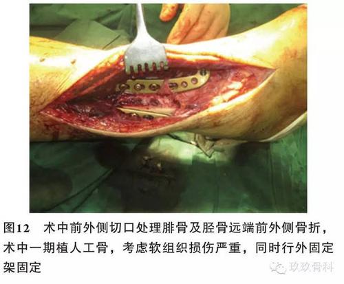 【玖玖学术园地】距下关节及腓骨肌腱松解术治疗跟骨骨折后踝关节