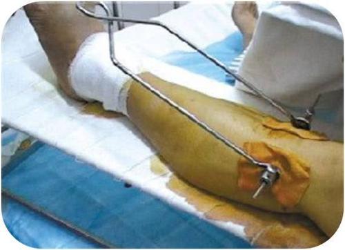 骨牵引的创新护理小发明,真的很实用!骨科病人有福了