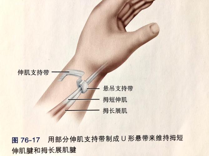 桡骨茎突狭窄性腱鞘炎dequervain病介绍