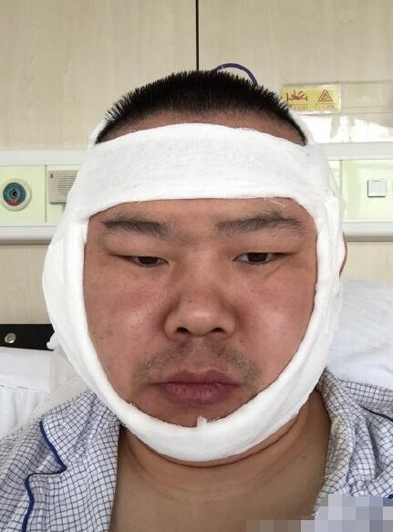 岳云鹏晒术后脸肿缠绷带照 不忘逗哏:不要笑好吗