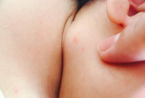 苹果绿 保健常识 很多的小婴儿在出生以后可能会患上奶癣,这是一种