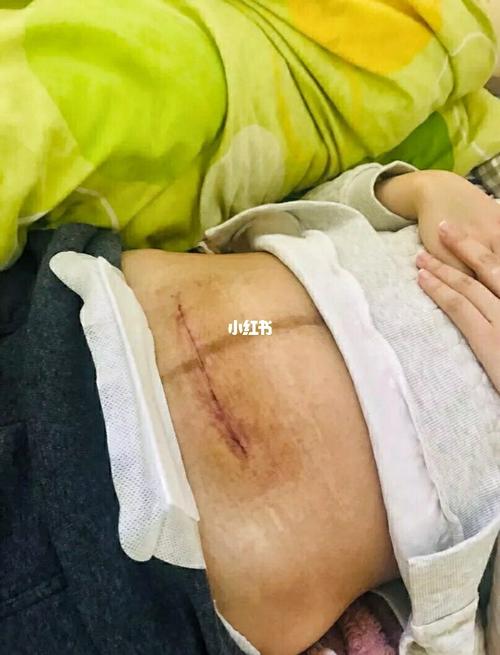 剖腹产_顺产_运动_束腹带_凝胶_尿不湿_产后修复_清洁_剖腹产经验