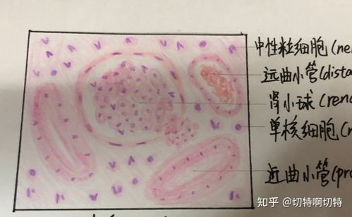 4.慢性肺淤血 有心衰细胞