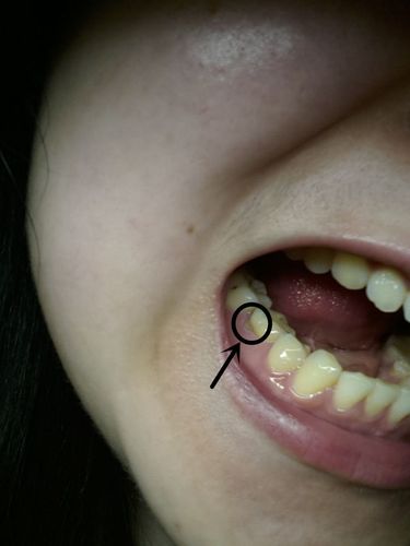 您好~牙龈突然缺了一块,牙根都露出来了是