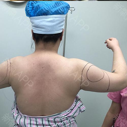 吸脂瘦手臂好不好_效果图_刘玉刚吸脂瘦手臂术后第0天_新氧美容整形