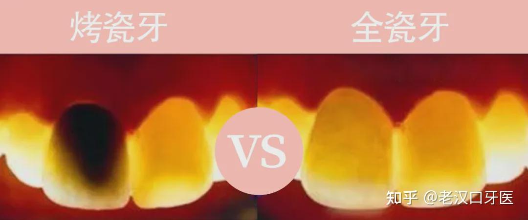 烤瓷牙内有金属不透光,全瓷牙与自然牙有非常近似的透光度,美学效果佳