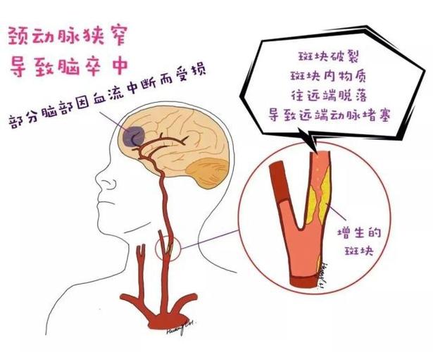 增生的斑块导致颈动脉管腔狭窄,狭窄的动脉内可形成小血栓,小血栓