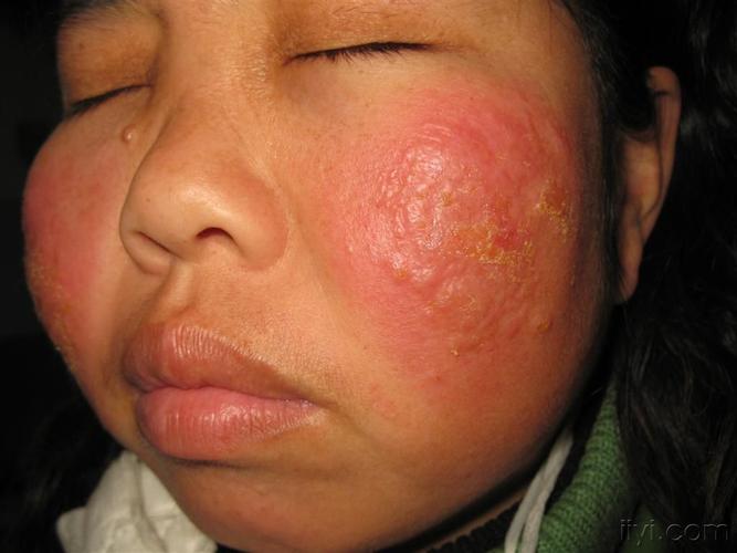 看图识病·····面部冻疮