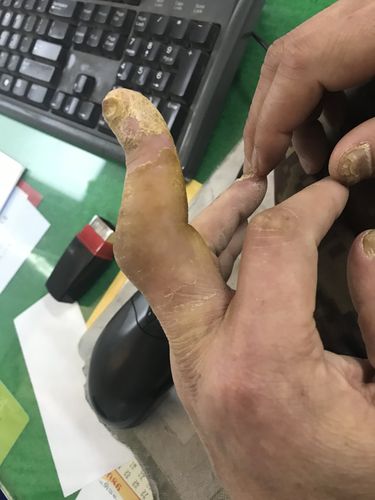 指间关节脱位小损伤引发了大问题