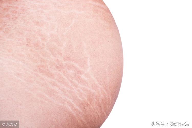 妊娠纹痒(十几年妊娠纹痒怎么办)