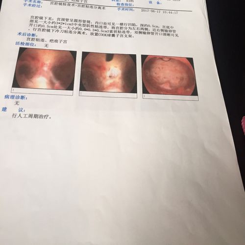 17年6月做了宫腔粘连分离术,术后放置了三个月的球囊支架和吃