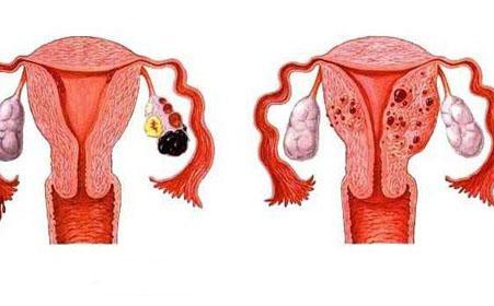 流产手术可能会促使子宫内膜经输卵管进入盆腔,而引起卵巢巧克力囊肿