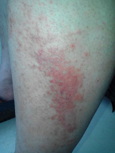 腿上有大面积的红色疹子 瘙痒 复发性强 看看有什么解决办法 有图片
