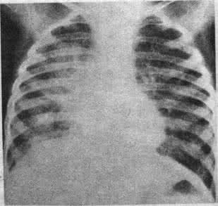 大叶性肺炎和小叶性肺炎的区别 肺炎是什么