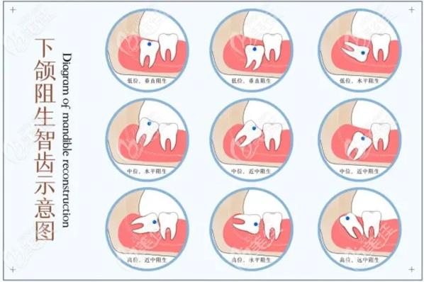 拔一颗智齿1500元合理吗看看这份收费标准就懂了