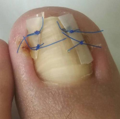 既往对于嵌入严重者,需先行局部阻滞麻醉,拔甲,并将部分两侧甲根组织