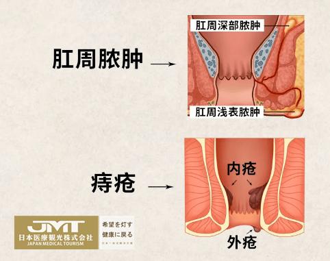 肛门周围疼痛是什么原因肛门口是身体的私密处,当肛门口发现异常卓鲻