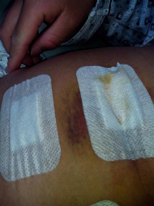 急性阑尾炎手术后3天左右,肚脐刀口附近全部黑紫,呈淤青状.