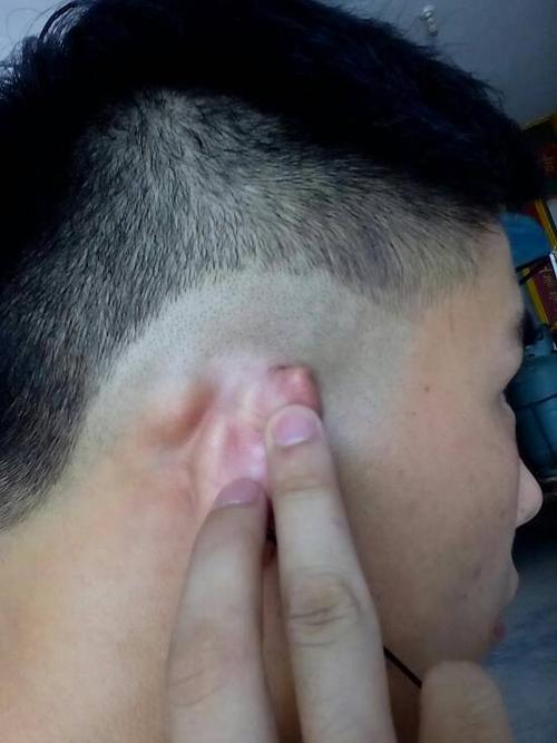 耳朵后面长了个硬疙瘩,跟骨头似的.不疼也不痒,平时也没有什么症状.