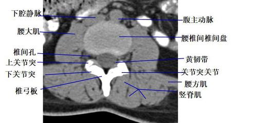 经腰椎椎弓根的横断层面(ct ) 1.