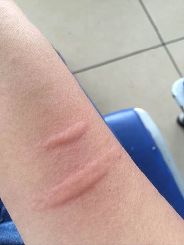 荨麻疹是什么样子的