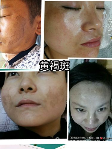 黄褐斑,片状斑,呈蝴蝶状属内分泌失调斑