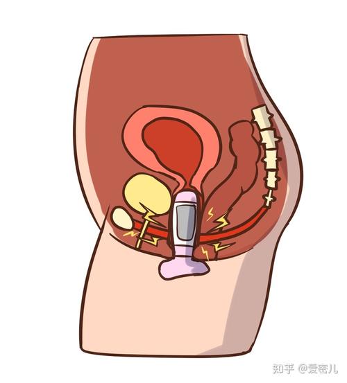 爱密儿:产后子宫脱垂,每个女人都应预防!
