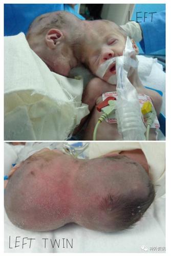 出生后28天,右侧婴儿突发青紫,紧接着多次呼吸暂停,最后心脏停搏而