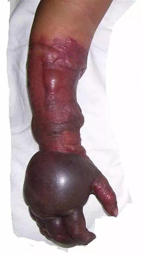 创伤性气性坏疽通常表现为手术或创伤部位突发的严重疼痛.