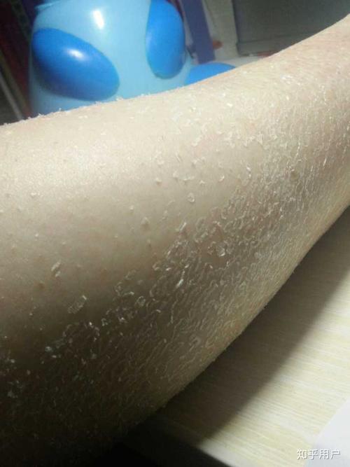 皮肤不好干成这个样子,没想到啊没想到我腿上这玩意是鱼鳞病还带点