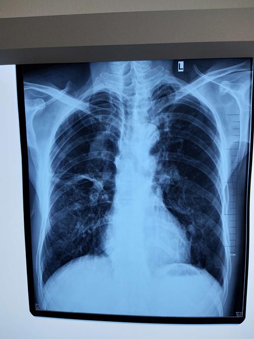 胸片:心界恢复正常,肺功能明显改善