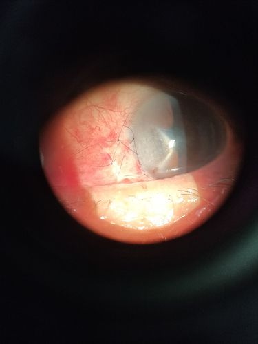 眼睛里长"息肉",小心翼状胬肉!