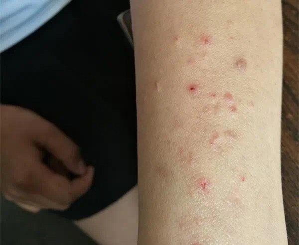 光过敏多形性日光疹