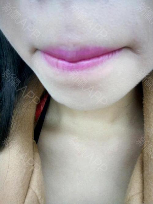 长沙脱唇毛好不好_效果图_阿细宝宝脱唇毛术后第5天