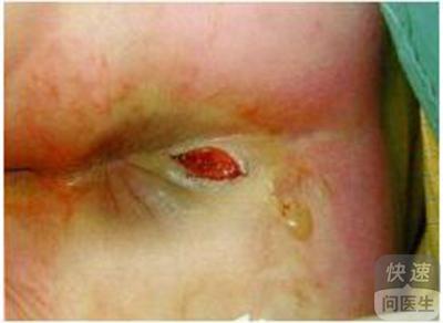 经常坐着的人就很容易造成这个肛门的血液循环不良,容易造成细菌的