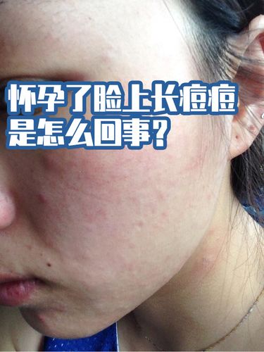 怀孕了脸上长痘痘是怎么回事?