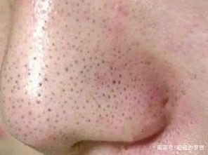 为什么人的鼻子上会有黑头,到底应该怎样解决"草莓鼻"?