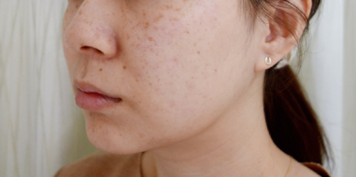 激光祛除雀斑项目分类皮肤管理祛斑祛痣激光祛斑