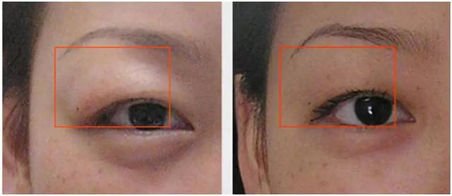 而前一天晚上又没喝太多水,这就要当心是不是肾脏出了问题,如慢性肾炎