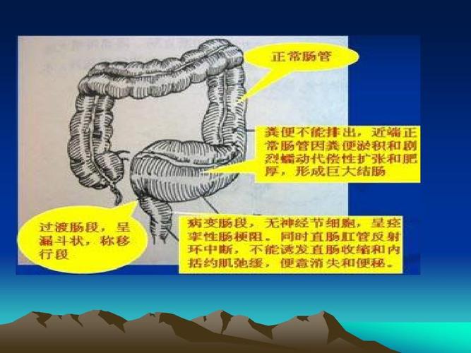 先天性巨结肠ppt
