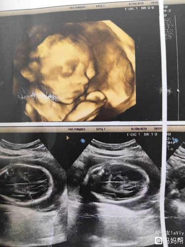 四维检查出宝宝鼻骨未显示,已做羊水穿刺