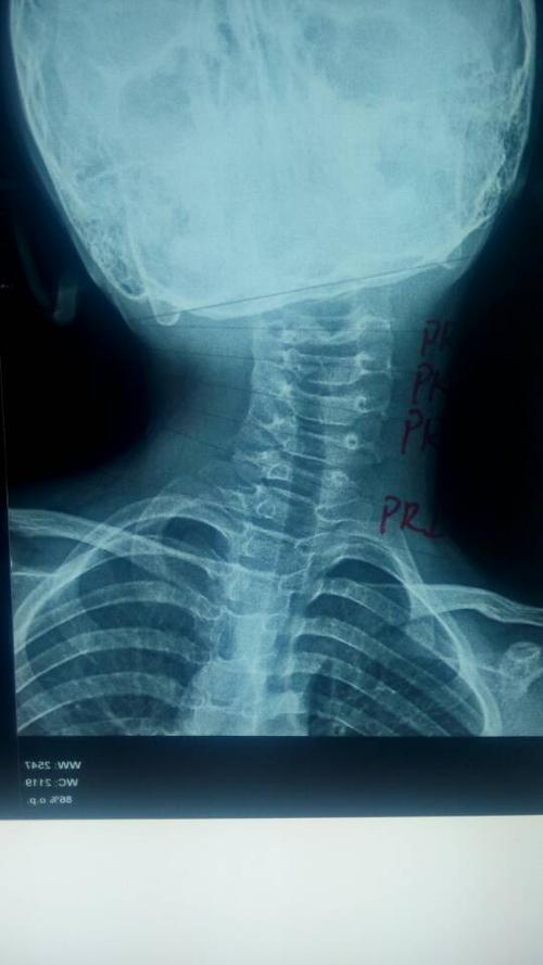 颈部x线正位片显示颈椎小关节紊乱,颈椎明显侧弯.