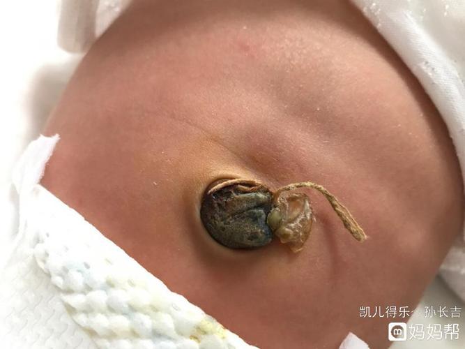 孩子都出生半个月了,肚脐还没掉,这怎么办