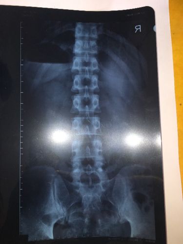 我有ct片,看红圈那里是不是应该有间隙啊?